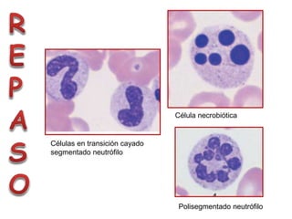Célula necrobiótica
Células en transición cayado
segmentado neutrófilo
Polisegmentado neutrófilo
 