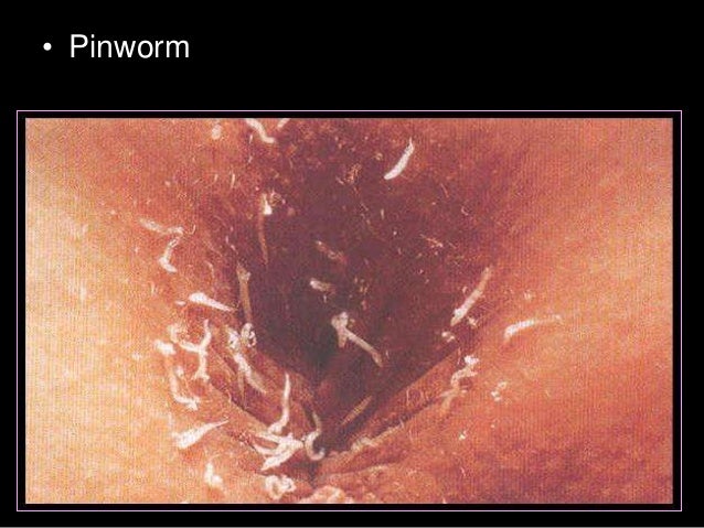 Ringworm Pictures: Rash, Skin Infections, Itching, Home ...