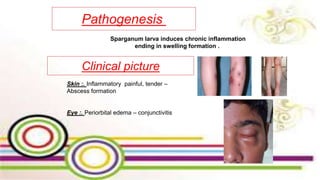 Pathogenesis
Sparganum larva induces chronic inflammation
ending in swelling formation .
Clinical picture
Skin :. Inflammatory painful, tender –
Abscess formation
Eye :. Periorbital edema – conjunctivitis
 