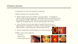 Clinical picture
 It depends on site and severity of infection.
 Most infections are asymptomatic.
 While A light Toxocara burden in young adults is thought to
induce a low immune response, allowing a larva to enter the host’s
eye leading to OLM. OLM often occurs in just one eye and from a
single larva migrating into and encysting within the orbit.
 Loss of vision occurs over days or weeks (due to chronic
inflammation of posterior chamber of eye leading to retinal
inflammation , retinal fibrosis, retinal detachment).
 Squint caused by haemorrhage at or near macula 
 Other signs and symptoms
 Red Eyes
 White pupil
 Retinal granulomas.
 