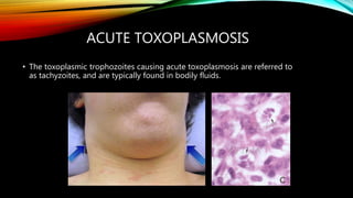 ACUTE TOXOPLASMOSIS
• The toxoplasmic trophozoites causing acute toxoplasmosis are referred to
as tachyzoites, and are typically found in bodily fluids.
 