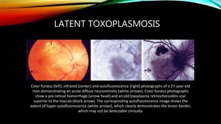 LATENT TOXOPLASMOSIS
Color fundus (left), infrared (center) and autofluorescence (right) photographs of a 27-year-old
man demonstrating an acute diffuse neuroretinitis (white arrows). Color fundus photographs
show a pre-retinal hemorrhage (arrow head) and an old toxoplasma retinochoroiditis scar
superior to the macula (black arrow). The corresponding autofluorescence image shows the
extent of hyper-autofluorescence (white arrows), which clearly demonstrates the lesion border,
which may not be detectable clinically.
 
