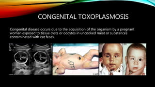 CONGENITAL TOXOPLASMOSIS
Congenital disease occurs due to the acquisition of the organism by a pregnant
woman exposed to tissue cysts or oocytes in uncooked meat or substances
contaminated with cat feces.
 