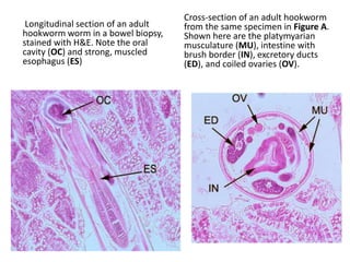 Longitudinal section of an adult
hookworm worm in a bowel biopsy,
stained with H&E. Note the oral
cavity (OC) and strong, muscled
esophagus (ES)
Cross-section of an adult hookworm
from the same specimen in Figure A.
Shown here are the platymyarian
musculature (MU), intestine with
brush border (IN), excretory ducts
(ED), and coiled ovaries (OV).
 
