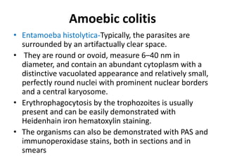 Amoebic colitis
• Entamoeba histolytica-Typically, the parasites are
surrounded by an artifactually clear space.
• They are round or ovoid, measure 6–40 nm in
diameter, and contain an abundant cytoplasm with a
distinctive vacuolated appearance and relatively small,
perfectly round nuclei with prominent nuclear borders
and a central karyosome.
• Erythrophagocytosis by the trophozoites is usually
present and can be easily demonstrated with
Heidenhain iron hematoxylin staining.
• The organisms can also be demonstrated with PAS and
immunoperoxidase stains, both in sections and in
smears
 