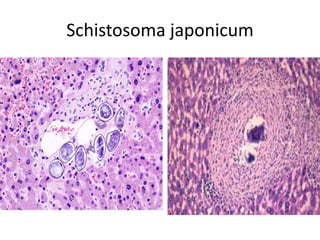 Schistosoma japonicum
 