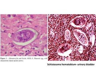Schistosoma hematobium- urinary bladder
 