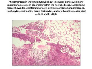 Photomicrograph showing adult worm cut in several planes with many
microfilariae also seen separately within the necrotic tissue. Surrounding
tissue shows dense inflammatory cell infiltrate consisting of polymorphs,
lymphocytes, eosinophils, foamy histiocytes, and small multinucleated giant
cells (H and E, ×200)
 