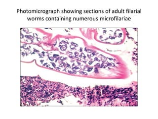 Photomicrograph showing sections of adult filarial
worms containing numerous microfilariae
 