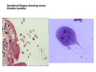 Duodenal biopsy showing many
Giardia Lamblia
 