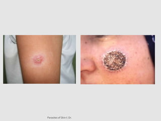Skinworm parasites of skin-1.pptx