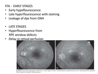 Parasitic infections of retina | PPTX