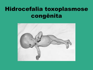 Hidrocefalia toxoplasmose
        congênita
 