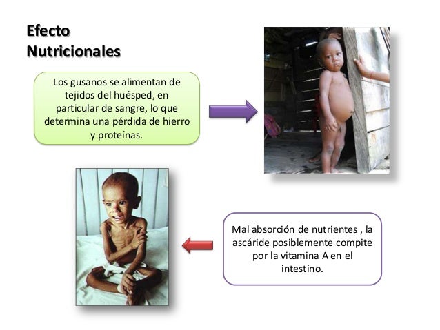 Como curan de los parásitos en el hígado