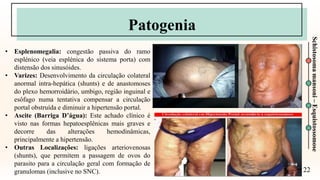 22
Schistosoma
mansoni
–
Esquistossomose
Patogenia
• Esplenomegalia: congestão passiva do ramo
esplénico (veia esplénica do sistema porta) com
distensão dos sinusóides.
• Varizes: Desenvolvimento da circulação colateral
anormal intra-hepática (shunts) e de anastomoses
do plexo hemorroidário, umbigo, região inguinal e
esôfago numa tentativa compensar a circulação
portal obstruída e diminuir a hipertensão portal.
• Ascite (Barriga D’água): Este achado clínico é
visto nas formas hepatoesplênicas mais graves e
decorre das alterações hemodinâmicas,
principalmente a hipertensão.
• Outras Localizações: ligações arteriovenosas
(shunts), que permitem a passagem de ovos do
parasito para a circulação geral com formação de
granulomas (inclusive no SNC).
 