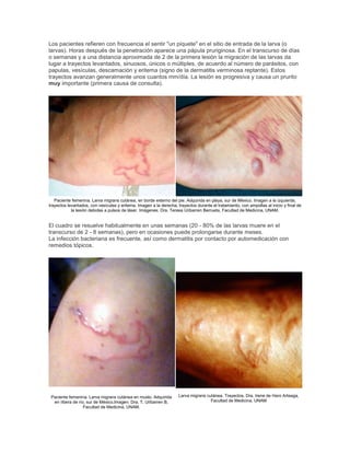 Los pacientes refieren con frecuencia el sentir "un piquete" en el sitio de entrada de la larva (o
larvas). Horas después de la penetración aparece una pápula pruriginosa. En el transcurso de días
o semanas y a una distancia aproximada de 2 de la primera lesión la migración de las larvas da
lugar a trayectos levantados, sinuosos, únicos o múltiples, de acuerdo al número de parásitos, con
papulas, vesículas, descamación y eritema (signo de la dermatitis verminosa reptante). Estos
trayectos avanzan generalmente unos cuantos mm/día. La lesión es progresiva y causa un prurito
muy importante (primera causa de consulta).
Paciente femenina. Larva migrans cutánea, en borde externo del pie. Adquirida en playa, sur de México. Imagen a la izquierda,
trayectos levantados, con vesículas y eritema. Imagen a la derecha, trayectos durante el tratamiento, con ampollas al inicio y final de
la lesión debidas a pulsos de láser. Imágenes: Dra. Teresa Uribarren Berrueta, Facultad de Medicina, UNAM.
El cuadro se resuelve habitualmente en unas semanas (20 - 80% de las larvas muere en el
transcurso de 2 - 8 semanas), pero en ocasiones puede prolongarse durante meses.
La infección bacteriana es frecuente, así como dermatitis por contacto por automedicación con
remedios tópicos.
Paciente femenina. Larva migrans cutánea en muslo. Adquirida
en ribera de río, sur de México.Imagen: Dra. T. Uribarren B,
Facultad de Medicina, UNAM.
Larva migrans cutánea. Trayectos. Dra. Irene de Haro Arteaga,
Facultad de Medicina, UNAM
 