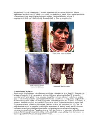 despigmentación (piel de leopardo) y también liquenificación (epidermis engrosada, formas
nodulares y descamación). La migración continua y prolongada de las Mf, junto con las respuestas
inflamatorias origina la pérdida de elasticidad cutánea y explica la fascies leonina. Al
engrosamiento de la piel más la pérdida de elasticidad, se debe la paquidermitis.
Liquenificación. WHO/TDR/Murdoch Facies leonina. WHO/TDR/Haaland
Piel de leopardo. Pt. africano.
WHO/APOC/TDR/Crump
Paquidermitis. WHO/TDR/Baldry
2. Alteraciones oculares.
Son producto de infecciones microfilarianas repetitivas, masivas o de larga duración, dependen de
la cepa del parásito, de la intensidad de la transmisión y de la inflamación. Las Mf se pueden
encontrar en el humor vítreo y en el acuoso y afectan las regiones anterior y posterior de ambos
ojos. La principal causa de las lesiones es la inflamación exacerbada en respuesta a los productos
de Wolbachia cuando las Mf son destruidas por los polimorfonucleares. En la córnea se presenta la
queratitis punteada, lesiones de corta evolución que se inician a partir de la abertura pupilar y se
dirigen a la periferia; se forman mientras los fragmentos de Mf son eliminados por fagocitos y al
final desaparecen. En la queratitis esclerosante, las lesiones se originan en los bordes pupilares,
confluyen hacia el centro de la abertura pupilar, no desaparecen con el parásito y opacan
permanentemente la córnea. Paulatinamente, la visión periférica se ve reducida y la función visual
limitada. También se producen iridociclitis, uveítis, atrofia del nervio óptico y otras alteraciones en
la retina que en conjunto, causan ceguera irreversible.
 
