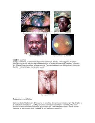 Queratitis. opacidad importante de córnea. WHO/TDR Queratitis esclerosante. WHO/TDR
Ceguera.. WHO/TDR/Crump Lesiones en fondo de ojo. WHO/TDR
c) Otros cuadros.
Aunque raramente, se presentan alteraciones sistémicas (renales y neurológicas) de origen
iatrogénico y se han descrito alteraciones linfáticas en la región crural (ingle colgante), originada
por inflamación y obstrucción linfática regional. También hay trastornos psicológicos y disfunción
familiar y comunitaria por marginación social.
Ingle colgante. WHO/TDR
Respuesta inmunológica:
La inmunidad elicitada contra Onchocerca es compleja. Existen mecanismos de tipo Th2 dirigidos a
la protección contra larvas L3 y Mf y se tiene evidencia de que tanto las vías Th1 y Th2 están
involucradas en la resistencia ante los gusanos adultos. La sobrevivencia de las filarias adultas
depende en gran medida de la inducción de una respuesta reguladora.
 