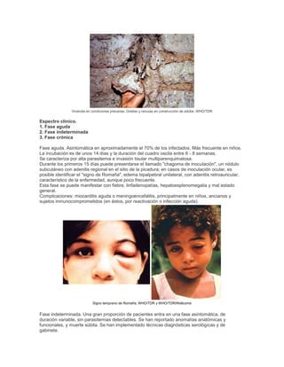 Vivienda en condiciones precarias. Grietas y ranuras en construcción de adobe. WHO/TDR
Espectro clínico.
1. Fase aguda
2. Fase indeterminada
3. Fase crónica
Fase aguda. Asintomática en aproximadamente el 70% de los infectados. Más frecuente en niños.
La incubación es de unos 14 días y la duración del cuadro oscila entre 6 - 8 semanas.
Se caracteriza por alta parasitemia e invasión tisular multiparenquimatosa.
Durante los primeros 15 días puede presentarse el llamado "chagoma de inoculación", un nódulo
subcutáneo con adenitis regional en el sitio de la picadura; en casos de inoculación ocular, es
posible identificar el "signo de Romaña", edema bipalpebral unilateral, con adenitis retroauricular,
característico de la enfermedad, aunque poco frecuente.
Esta fase se puede manifestar con fiebre, linfadenopatías, hepatoesplenomegalia y mal estado
general.
Complicaciones: miocarditis aguda o meningoencefalitis, principalmente en niños, ancianos y
sujetos inmunocomprometidos (en éstos, por reactivación o infección aguda).
Signo temprano de Romaña. WHO/TDR y WHO/TDR/Wellcome
Fase indeterminada. Una gran proporción de pacientes entra en una fase asintomática, de
duración variable, sin parasitemias detectables. Se han reportado anomalías anatómicas y
funcionales, y muerte súbita. Se han implementado técnicas diagnósticas serológicas y de
gabinete.
 