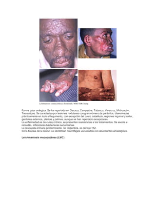 Leishmaniasis cutánea difusa o diseminada. WHO/TDR/Crump.
Forma polar anérgica. Se ha reportado en Oaxaca, Campeche, Tabasco, Veracruz, Michoacán,
Tamaulipas. Se caracteriza por lesiones nodulares con gran número de parásitos, diseminadas
prácticamente en todo el tegumento, con excepción del cuero cabelludo, regiones inguinal y axilar,
genitales externos, plantas y palmas, aunque se han reportado excepciones.
La enfermedad es de curso crónico, se presentan resistencias a los tratamientos. Se asocia a
recaídas, infecciones bacterianas secundarias.
La respuesta inmune predominante, no protectora, es de tipo Th2.
En la biopsia de la lesión, se identifican macrófagos vacuolados con abundantes amastigotes.
Leishmaniosis mucocutánea (LMC)
 