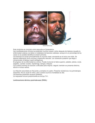WHO/TDR/Crump
Este síndrome es conocido como espundia en Sudamérica.
Las manifestaciones clínicas se presentan muchos meses o años después de haberse resuelto la
enfermedad cutánea; se deben a metástasis de lesiones cutáneas, aunque en un porcentaje de los
casos no es posible identificar la lesión primaria.
Las lesiones se inician principalmente en mucosa nasal, simulando en el inicio una rinitis. Se
aprecia inflamación de la mucosa e hipertrofia vascular, con ulceración posterior que llega a
comprometer el tabique nasal cartilaginoso.
El progreso de la enfermedad es crónico. Puede involucrar el labio superior, paladar, pilares, úvula,
epiglotis, cuerdas vocales, hipofaringe, laringe y tráquea.
Los cuadros severos se asocian a dificultad para respirar, deglutir; también se presenta disfonía,
afonía e incluso asfixia.
La infección secundaria es frecuente y complica el cuadro. Presenta resistencia a la quimioterapia
específica. No es usual en niños, pero cuando ocurre la mortalidad es alta.
Las lesiones presentan escasos parásitos.
La respuesta inmune predominante es de tipo Th1.
Leishmaniosis dérmica post-kala-azar (PKDL)
 