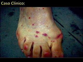 No dia 11 de maio de 2009, uma senhora procedente da Cidade do Recife observou lesões circulares, hiperêmicas em suas
pernas e pés (Figura 1), em uma observação mais aprofundada a mesma verificou a presença de um ectoparasito no centro
da lesão. O mesmo foi removido por torção em sentido anti-horário e dois espécimes foram postos em álcool 70%.
Em seguida os ectoparasitos foram conduzidos ao Laboratório de Doenças Parasitárias dos Animais Domésticos da
Universidade Federal Rural de Pernambuco para identificação. Os espécimes foram analisados, clarificados e montados em
lâminas de microscopia. Em seguida, foram observados em microscópio óptico e identificados com o auxílio de chave
dicotômica. De acordo com a análise morfológica o carrapato foi identificado como sendo pertencente ao gênero
Amblyomma. A ocorrência de carrapatos em humanos tem sido descritos no Brasil. Tendo sido identificado parasitismo por
R. sanguineus, R. (B.) microplus, além de espécies pertencentes ao gênero Amblyomma.
Estes carrapatos possuem baixa especificidade parasitária, principalmente nos estágios de larva e ninfa, o que faz com que
parasitem diferentes classes de animais incluindo humanos. A ocorrência do parasitismo em humanos por Amblyomma sp
requer grande atenção, tendo em vista a capacidade que estes carrapatos possuem de transmitir agentes patogênicos ao
homem. Dentre estes agentes patogênicos destacam-se algumas bactérias como Ehrlichia sp, Coxiella burnetti, Borrelia sp,
além da Rickettsia rickettsii, sendo este último agente o responsável pela febre maculosa.
A transmissão de Rickettsia rickettsii na maior parte das áreas endêmicas encontra-se relacionada à ocorrência de
parasitismo em humanos por carrapatos, notadamente pertencentes ao gênero Amblyomma. Além das bactérias já
citadas, protozoários como Trypanossoma sp já foram descritos parasitando estes ixodídeos. Neste contexto, o achado
constitui um potencial problema de Saúde Pública em virtude dos agentes transmitidos aos humanos por estes carrapatos
já descritos na literatura.
Este fato ressalta ainda mais a importância de estudos referentes ao parasitismo destes ectoparasitos em humanos. Alerta-
se desta forma, que medidas preventivas se fazem necessário, notadamente quando se realiza atividades em áreas de
mata, potencialmente infestadas por formas imaturas de Amblyomma sp, pois sabe-se que carrapatos por possuírem baixa
especificidade parasitária podem acometer diferentes mamíferos facilitando sua manutenção e dispersão nestas áreas.
 