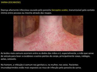 Doença altamente infecciosa causada pelo parasita Sarcoptes scabie, transmissível pelo contato
íntimo entre pessoas ou mesmo através das roupas.
As lesões mais comuns ocorrem entre os dedos das mãos e é, especialmente, a mão que serve
de veículo para levar a escabiose a outros pontos do corpo, principalmente coxas, nádegas,
axilas, cotovelo.
No homem, a infecção é comum nos genitais e, na mulher, nos seios. Pacientes
imunodeprimidos estão mais expostos ao risco de infecção pelo parasita da sarna.
SARNA (ESCABIOSE)
 