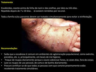 Tratamento
Escabicidas, exceto acima da linha do nariz e das orelhas, por dois ou três dias.
Repetida depois de 7 a 10 dias . Já existem remédios por via oral.
Toda a família e/ou parceiros devem ser tratados simultaneamente para evitar a reinfestação.
Recomendações
• Saiba que a escabiose é comum em ambientes de aglomeração populacional, como exército,
presídios, etc. e, principalmente, em locais de má higiene;
• Troque de roupas diariamente porque o ácaro sobrevive horas, às vezes dias, fora do corpo;
• Lave as roupas de uso pessoal, de cama e de banho diariamente;
• Procure certificar-se de que todas as pessoas com que convive proximamente estão
recebendo tratamento simultâneo.
 