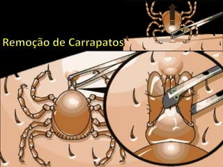 1 - A larva ou ninfa consome o sangue de um hospedeiro infectado. Durante o processo, ela
leva organismos infectados, como bactérias, para dentro de seu corpo. Os organismos ficam
no aparelho bucal e nas glândulas salivares do carrapato.
2 - Quando o carrapato encontra seu próximo hospedeiro, ele introduz seu aparelho bucal na
pele do hospedeiro e começa a sugar o sangue dele. A saliva do carrapato vai para dentro da
ferida para evitar que o sangue coagule. A saliva leva substâncias infectadas para dentro da
ferida. Se for espremido enquanto estiver preso na pele ou durante uma tentativa de removê-
lo, o carrapato pode regurgitar o sangue infectado dentro da ferida.
3 - O hospedeiro infectado se torna um novo reservatório de doença para outros carrapatos.
 