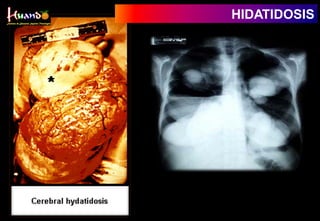 HIDATIDOSIS
 