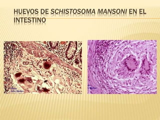 HUEVOS DE SCHISTOSOMA MANSONI EN EL 
INTESTINO 
 
