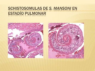 SCHISTOSOMULAS DE S. MANSONI EN 
ESTADÍO PULMONAR 
 