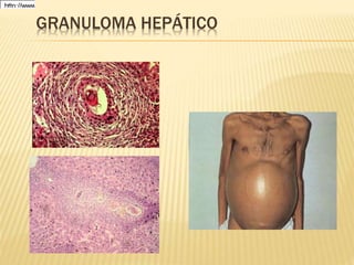 GRANULOMA HEPÁTICO 
1hFt5itrp0s:t2/ /g1we9wnwo 
 