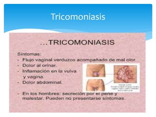 Tricomoniasis
 
