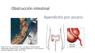 Obstrucción intestinal
Apendicitis por ascaris
Alves, E. B. D. S., Conceição, M. J., & Leles, D. (2016). Ascaris
lumbricoides, Ascaris suum, or “Ascaris lumbrisuum”?. The Journal of
Infectious Diseases, 213(8), 1355-1355.
 