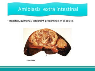 • Hepática, pulmonar, cerebral predominan en el adulto.
Amibiasis extra intestinal
 