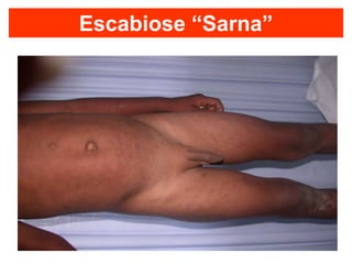 Escabiose “Sarna”
 