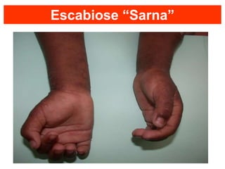 Escabiose “Sarna”
 