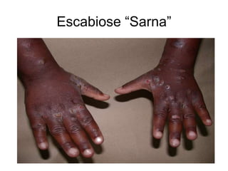Escabiose “Sarna”
 