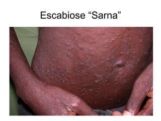 Escabiose “Sarna”
 