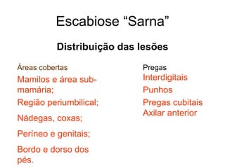 Escabiose “Sarna”
Distribuição das lesões
Áreas cobertas
Mamilos e área sub-
mamária;
Região periumbilical;
Nádegas, coxas;
Períneo e genitais;
Bordo e dorso dos
pés.
Pregas
Interdigitais
Punhos
Pregas cubitais
Axilar anterior
 
