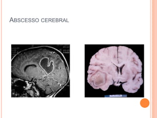ABSCESSO CEREBRAL
 