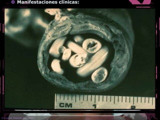  Manifestaciones clínicas:
Síntomas gastrointestinales, fiebre; se puede
desarrollar obstrucción intestinal aguda.
 Periodo de incubación:
De 1 a 2 semanas.
 Pruebas diagnósticas:
Coproparasitoscopía.
 Tratamiento:
Pamoato de pirantelo ( 11 mg/kg) en dosis única. Para
infección.
Mebendazol (100mg dos veces al día durante 3 días).
Albendazol.
E.E Aguilar Reséndiz Ana Karen
 