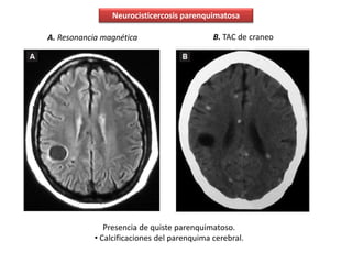 Neurocisticercosis parenquimatosa
A. Resonancia magnética B. TAC de craneo
Presencia de quiste parenquimatoso.
• Calcificaciones del parenquima cerebral.
 