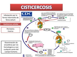 Infestación por la
forma intermedia de
Tenia solium
Cysticercus celulae
Peristalsis
inversa
Diseminación de
oncosferas por vía
hematogena a casi
cualquier parte del
cuerpo humano.
 