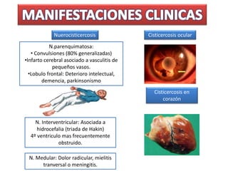 N.parenquimatosa:
• Convulsiones (80% generalizadas)
•Infarto cerebral asociado a vasculitis de
pequeños vasos.
•Lobulo frontal: Deterioro intelectual,
demencia, parkinsonismo
Cisticercosis ocular
Cisticercosis en
corazón
N. Interventricular: Asociada a
hidrocefalia (triada de Hakin)
4º ventriculo mas frecuentemente
obstruido.
N. Medular: Dolor radicular, mielitis
tranversal o meningitis.
Nuerocisticercosis
 