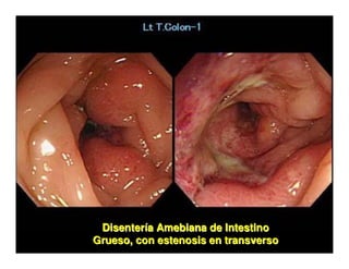 Parasitosis Intestinales Humanas