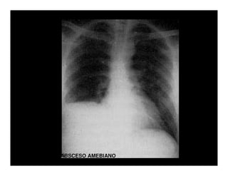 Parasitosis Intestinales Humanas