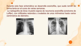 Durante esta fase sintomática se desarrolla eosinofilia, que suele remitir de
forma lenta en el curso de varias semanas.
La radiografía de tórax muestre signos de neumonía eosinófila (síndrome de
Loffler), con infiltrados redondos u ovalados de unos milímetros hasta varios
centímetros de diámetro.
 
