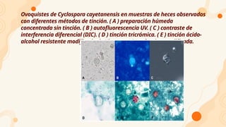 Ovoquistes de Cyclospora cayetanensis en muestras de heces observados
con diferentes métodos de tinción. ( A ) preparación húmeda
concentrada sin tinción. ( B ) autofluorescencia UV. ( C ) contraste de
interferencia diferencial (DIC). ( D ) tinción tricrómica. ( E ) tinción ácido-
alcohol resistente modificada de Kinyoun. ( F ) safranina modificada.
 